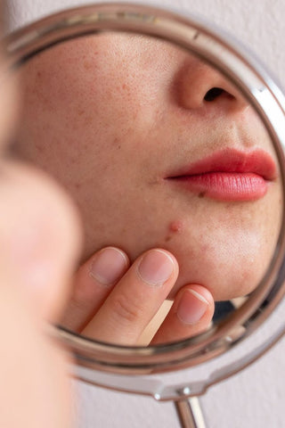 De magie van pimple patches