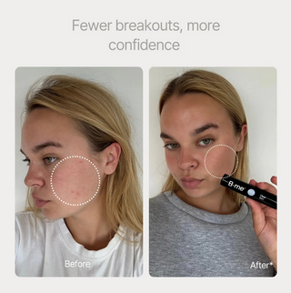 Clear Skin shots (28x25ml) - Acné
