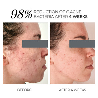 Violet Water D-spot - acné - Bio'ty Lab